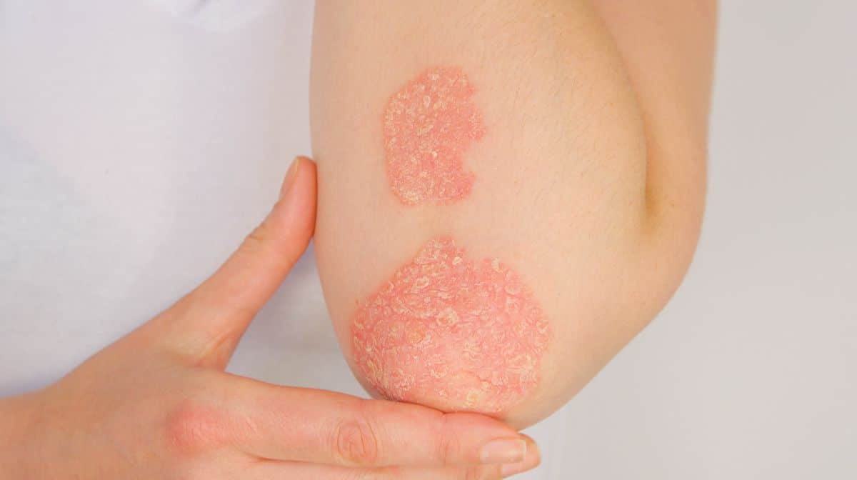 Psoriasis sur le coude