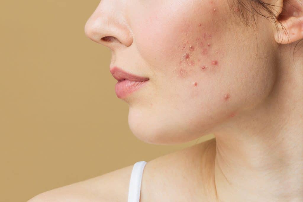 Visage d'une jeune femme de profil avec de l'acné hormonal