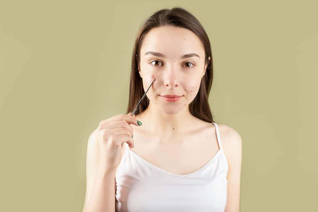 Jeune femme avec de l'acné